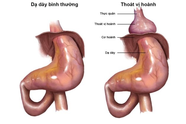 Thoát vị hoành gây trào ngược dạ dày thực quản