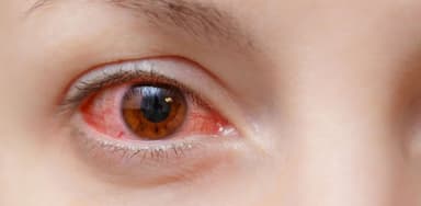 Tìm hiểu về bệnh viêm kết giác mạc mắt