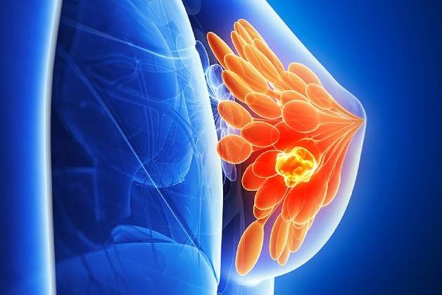 tầm soát ung thư vú ca 15.3