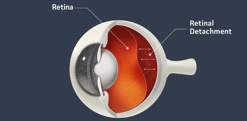 Tìm hiểu về các bệnh lý võng mạc thường gặp