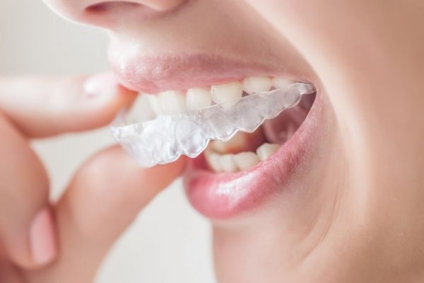 Khay niềng giúp nắn chỉnh nha một cách hiệu quả, mang lại nụ cười tự tin cho mọi người