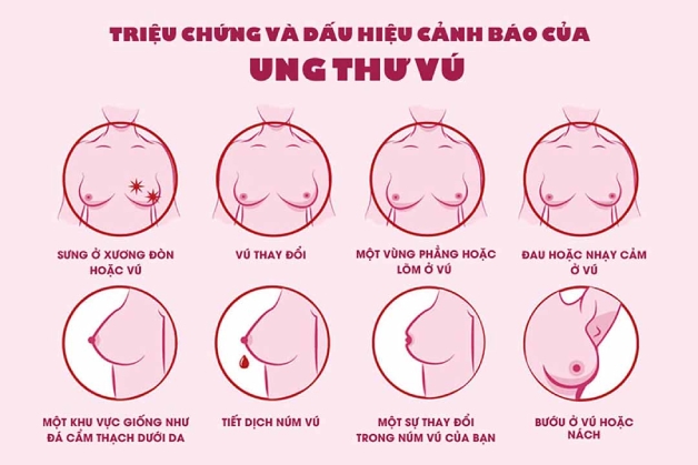 dấu hiệu của ung thư vú