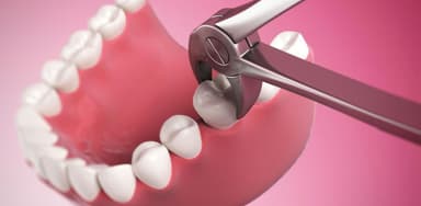 Giải đáp nha khoa: Vì sao niềng răng phải nhổ răng?