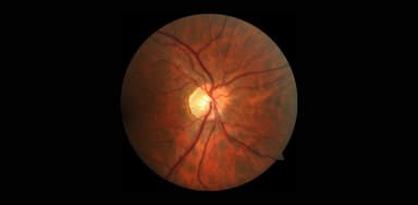 Viêm dây thần kinh thị giác: Nguyên nhân, dấu hiệu, cách điều trị