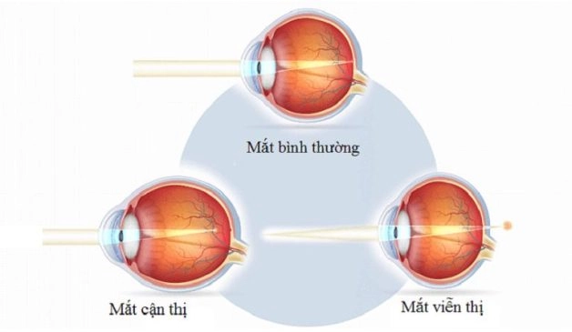 kính viễn thị