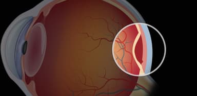 Võng mạc mắt và các bệnh lý võng mạc thường gặp