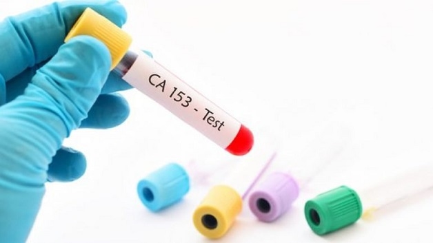 chỉ số xét nghiệm ung thư vú