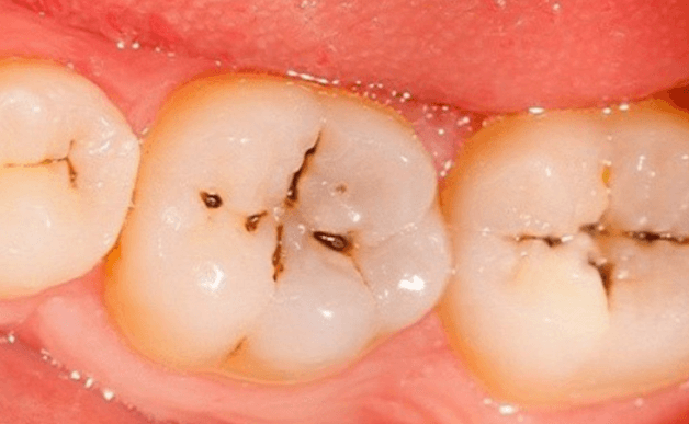 cách ngừa sâu răng