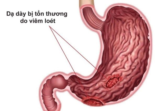 Đau thượng vị cảnh báo về viêm loét dạ dày