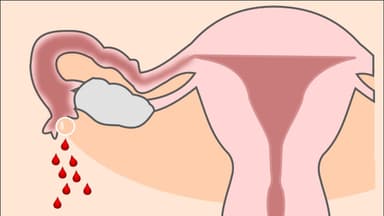 Mấy tuần có thể phát hiện chửa ngoài tử cung?