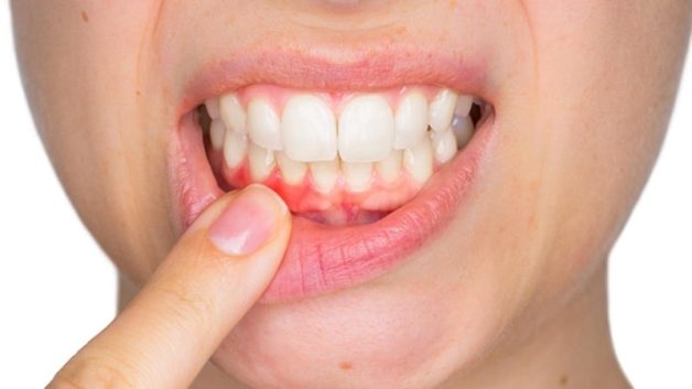 dấu hiệu bị viêm lợi