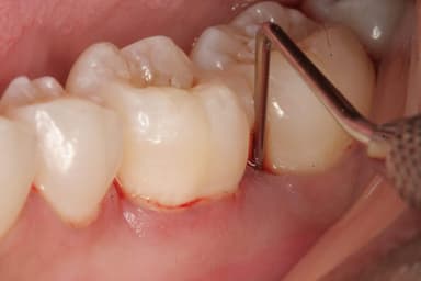 Dấu hiệu bị viêm lợi và cách điều trị hiệu quả