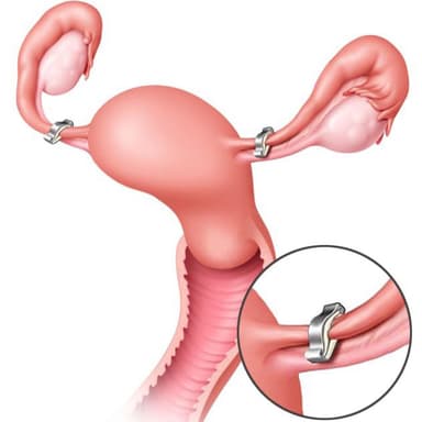 Mẹ đẻ thường có thắt ống dẫn trứng được không?
