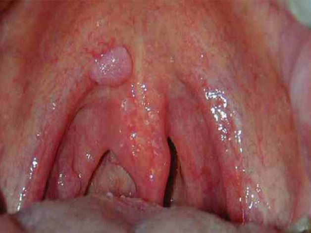 ung thư vòm họng nguy hiểm ra sao