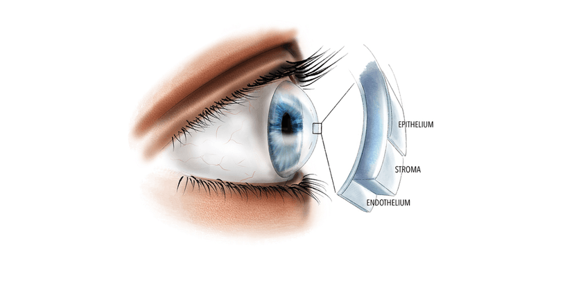 Loạn dưỡng giác mạc: Dấu hiệu, nguyên nhân, cách điều trị