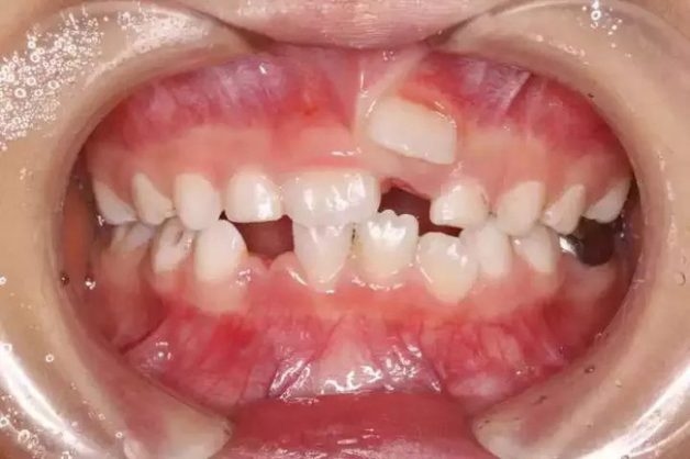 nắn chỉnh răng cho trẻ em