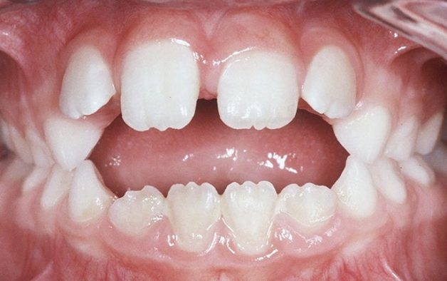 nắn chỉnh răng cho trẻ em