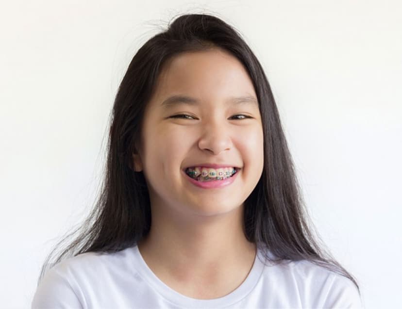 Nắn chỉnh răng cho trẻ em ở độ tuổi nào hiệu quả nhất?