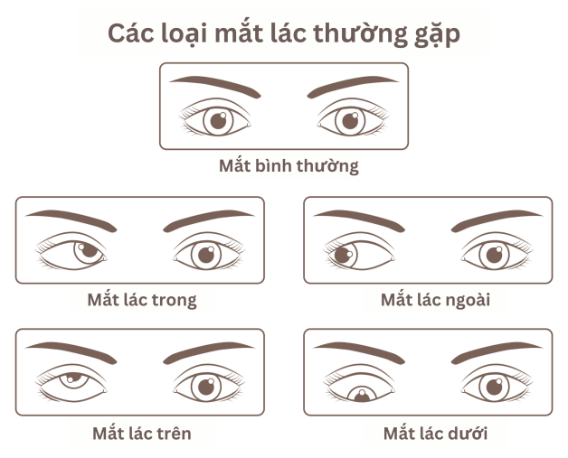 mắt bị lác nhẹ