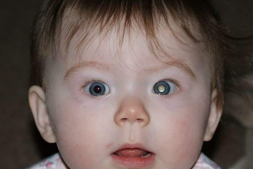 Nguyên nhân và dấu hiệu u nguyên bào võng mạc ở trẻ