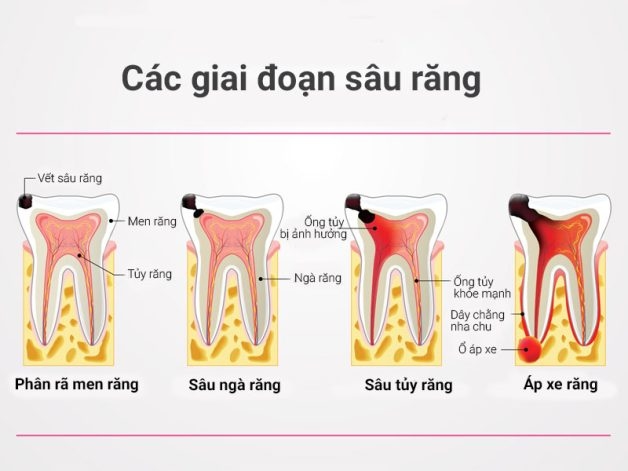 sâu men răng