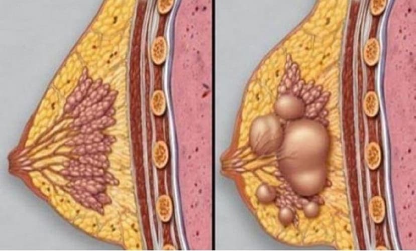 Mẹ bị tắc sữa làm thế nào để cho con ăn?