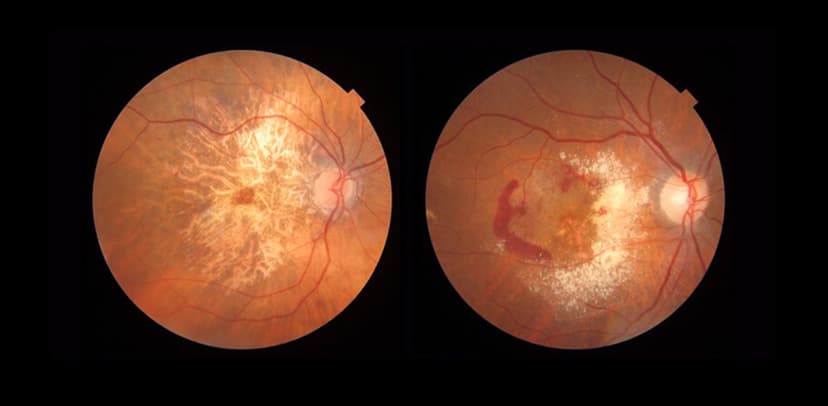 Hiểu đúng về thoái hóa điểm vàng ở mắt