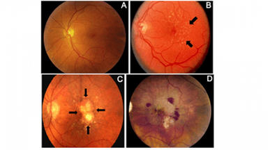 Thoái hóa hoàng điểm mắt là gì? Nguyên nhân do đâu?