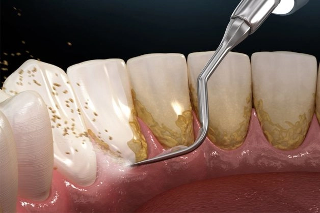 vì sao phải lấy cao răng
