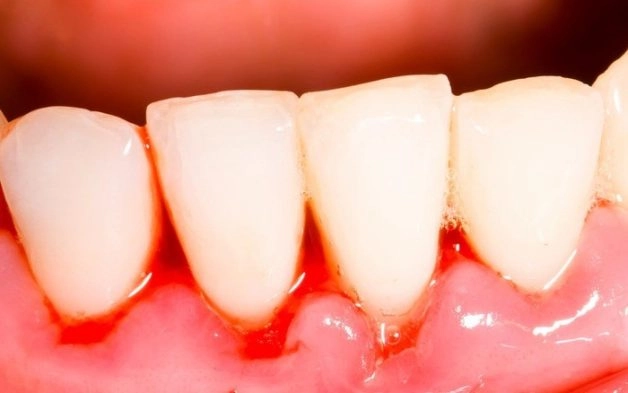 viêm lợi chảy máu chân răng