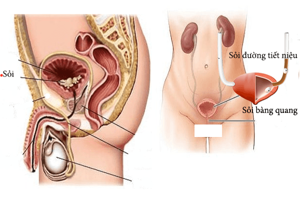 cách trị sỏi bàng quang hiệu quả