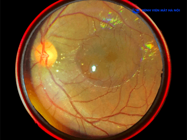 Bệnh hắc võng mạc trung tâm và những điều bạn cần biết!