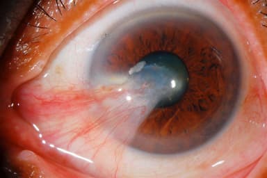 Bệnh mộng mắt: Biểu hiện, nguyên nhân và cách điều trị