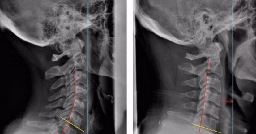 Vôi hóa đốt sống cổ: Nguyên nhân và cách điều trị hiệu quả