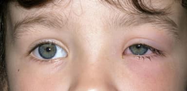 Dấu hiệu nhận biết viêm mí mắt dưới và cách điều trị