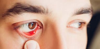 Triệu chứng và nguyên nhân bị đau mắt hột