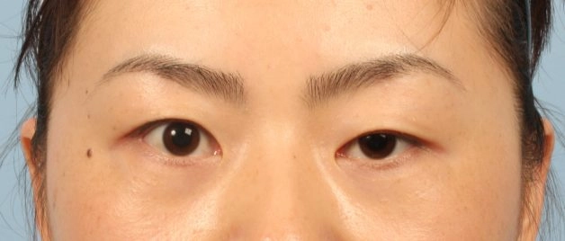 mắt bị sụp mí 1 bên ở người trưởng thành