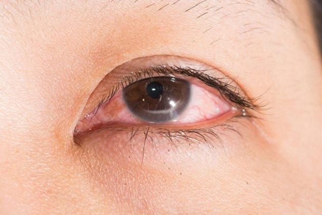 Bệnh tăng nhãn áp có chữa được không