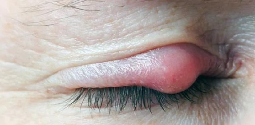 Dấu hiệu mắt nổi lẹo và cách điều trị an toàn, hiệu quả