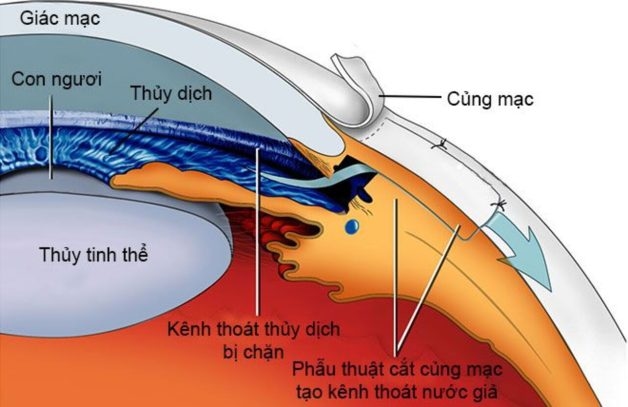 nguyên nhân tăng nhãn áp