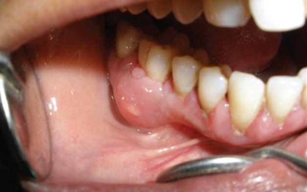 răng vĩnh viễn bị sâu