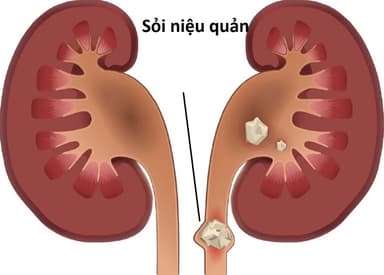 Giải đáp: Sỏi niệu quản có tán được không?