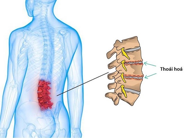 Thoái đốt sống lưng