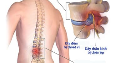 Nguyên nhân, triệu chứng và cách điều trị thoái hóa cột sống lưng