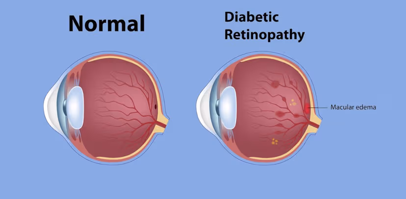 Bệnh phù hoàng điểm là gì, có nguy hiểm không?
