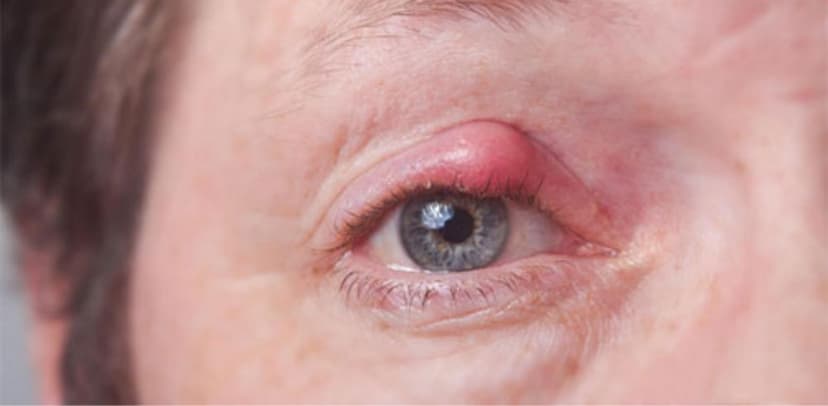 Chắp mắt trẻ em và những điều cần biết