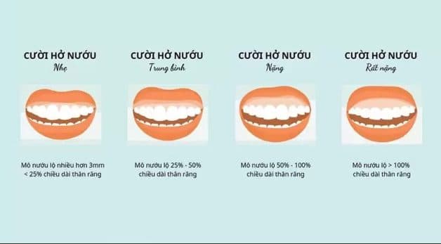 điều trị cười hở lợi