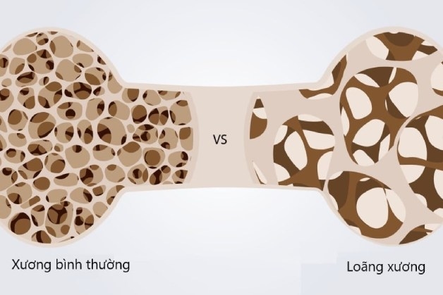 loãng xương là bệnh gì