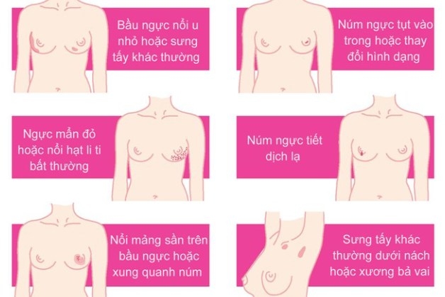 dấu hiệu ung thư vú sớm