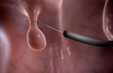 Là phụ nữ, chớ chủ quan với polyp tử cung